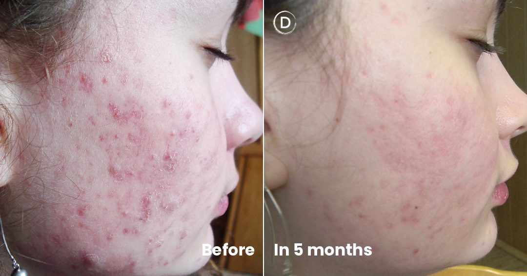 Clear Skin Clear Confidence Before After With Isotretinoin