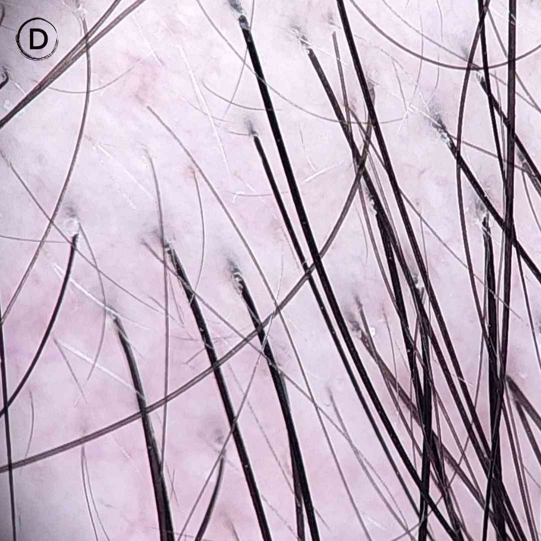 Trichoscopy of male androgenetic alopecia