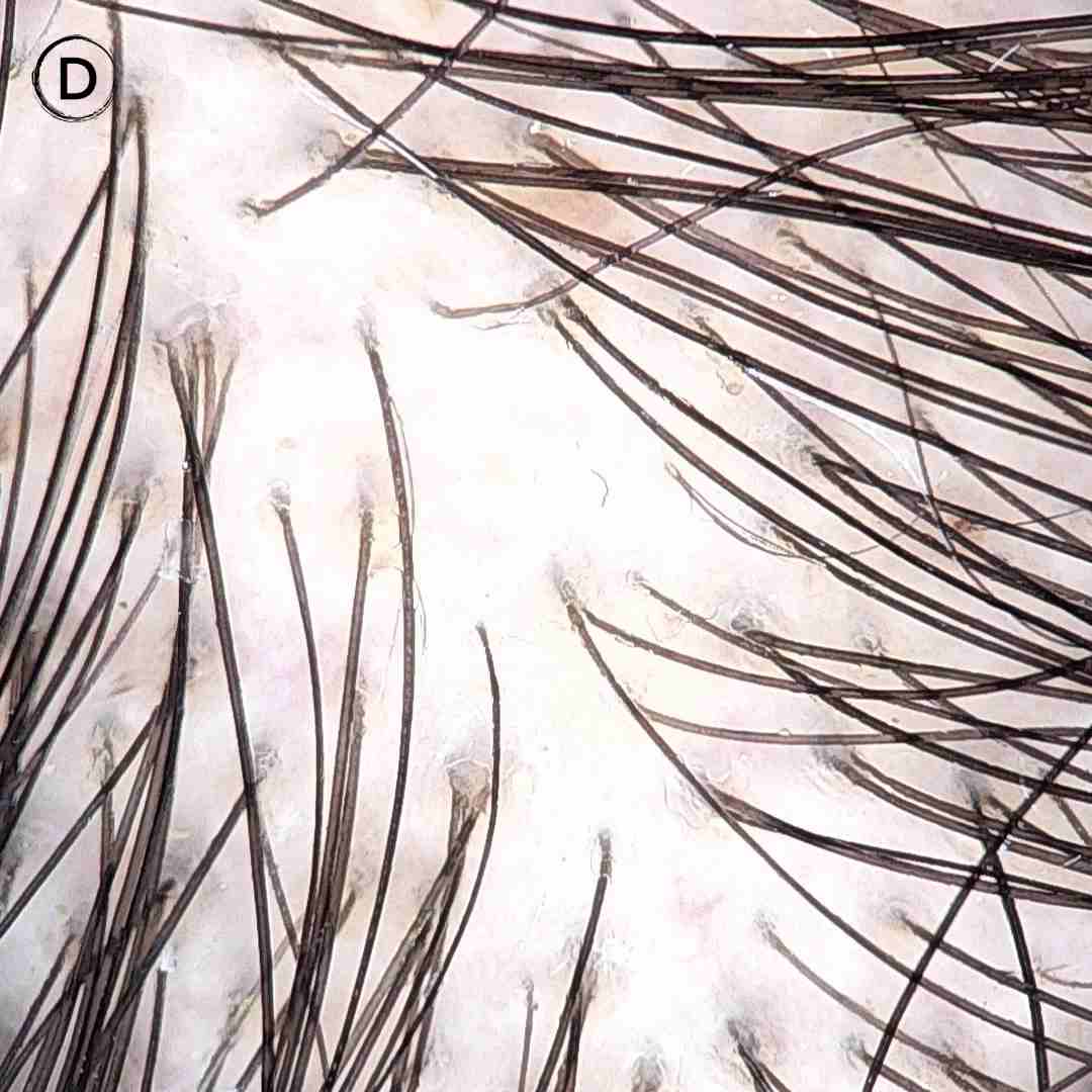 Trichoscopy of female pattern hair loss