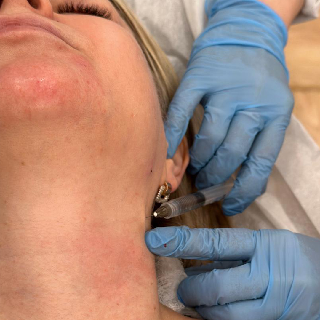Belotero filler injection procedure at Dermatology Circle NYC