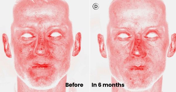 107-before-after-rosacea-treatment-small