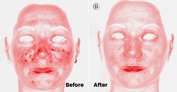 109-before-after-rosacea-IPL-NdYAG-treatment-small
