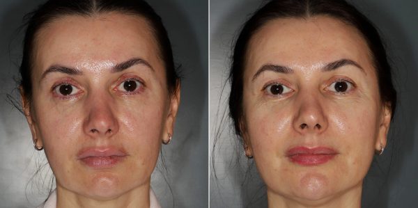 114-before-after-combination-rejuvenation-treatment