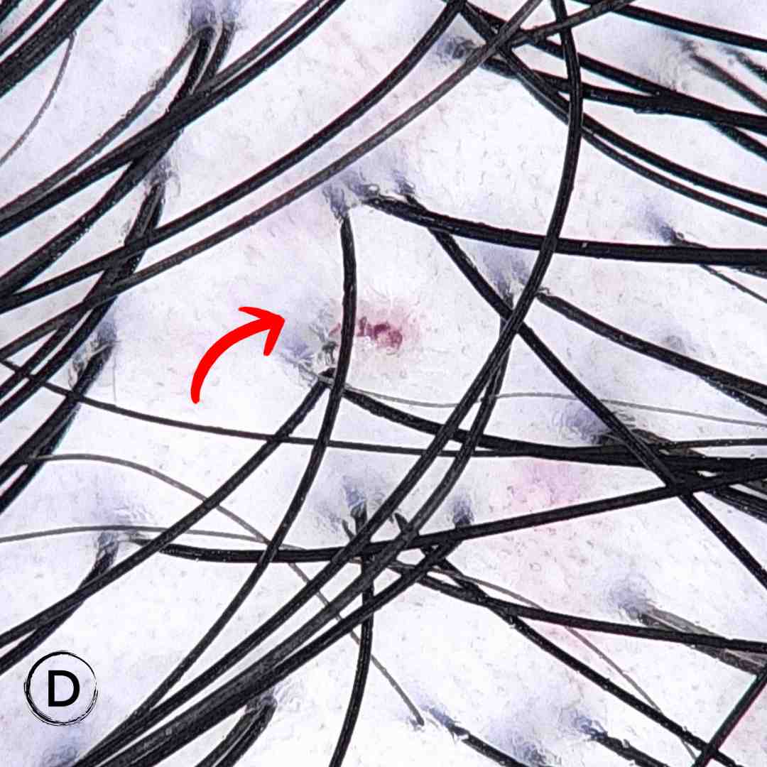 Trichoscopy image showing inflammatory follicular scalp lesion