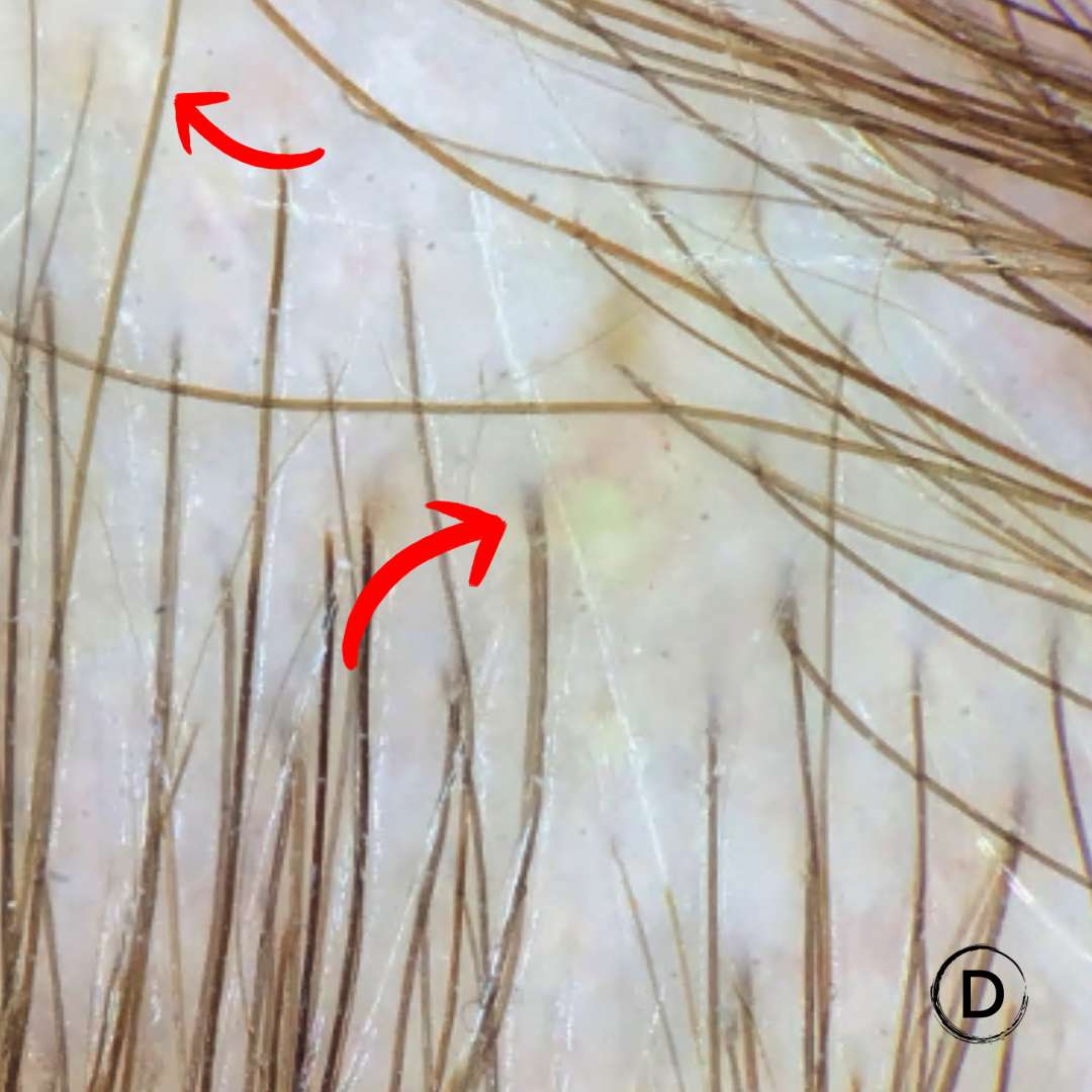 Trichoscopy image showing scalp folliculitis under magnification