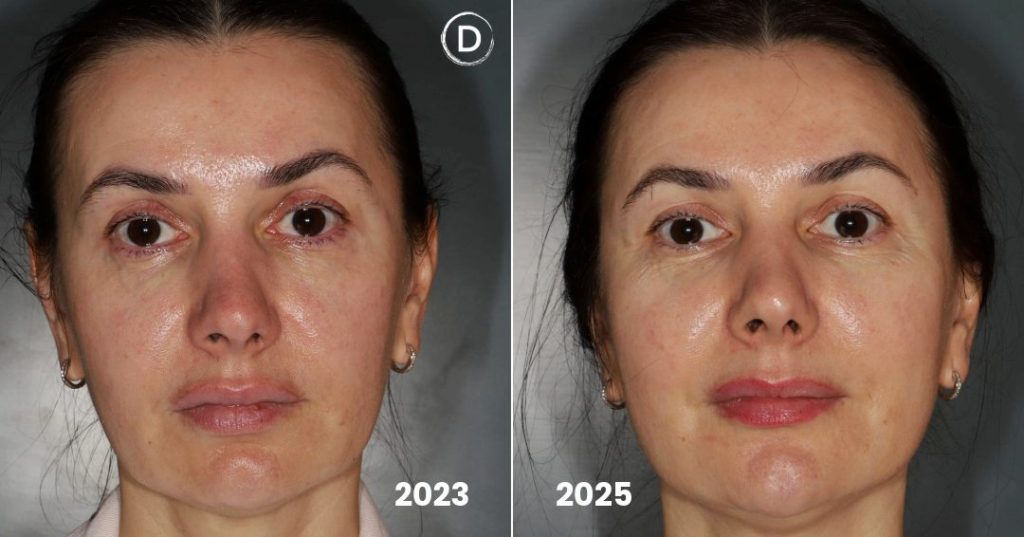 Before and after skin tightening treatment — Sofwave fillers Sculptra and laser resurfacing at Dermatology Circle Upper East Side NYC — 2 year result