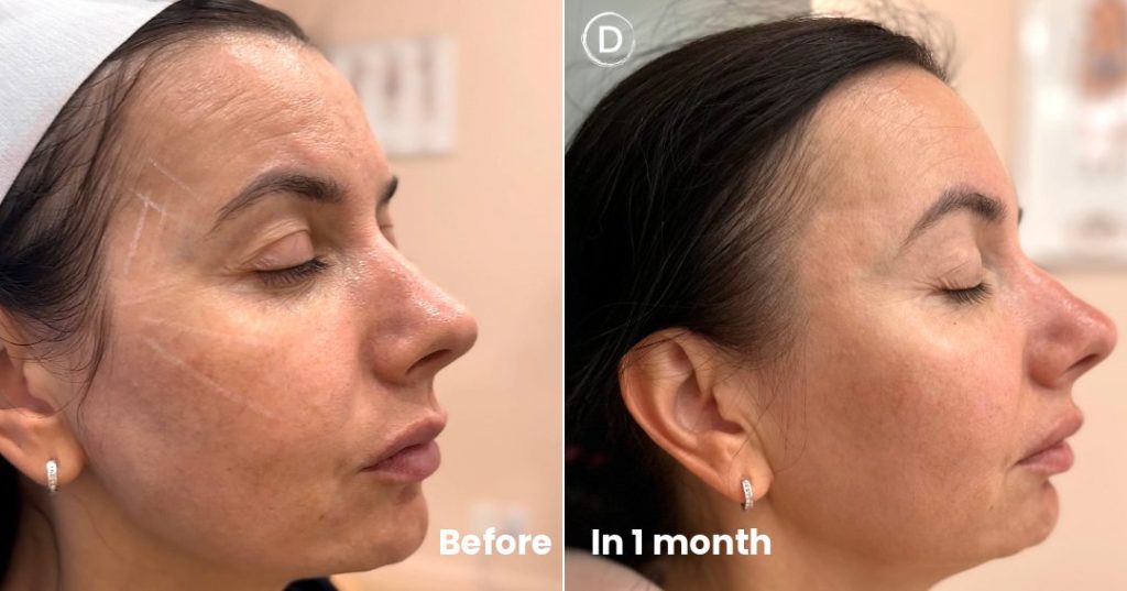 Before and after cheek filler treatment at one month for facial volume loss in NYC