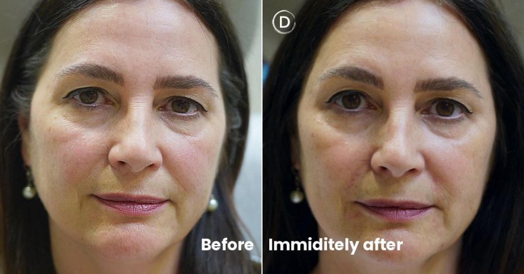 Before and after facial filler treatment for volume loss at Dermatology Circle NYC