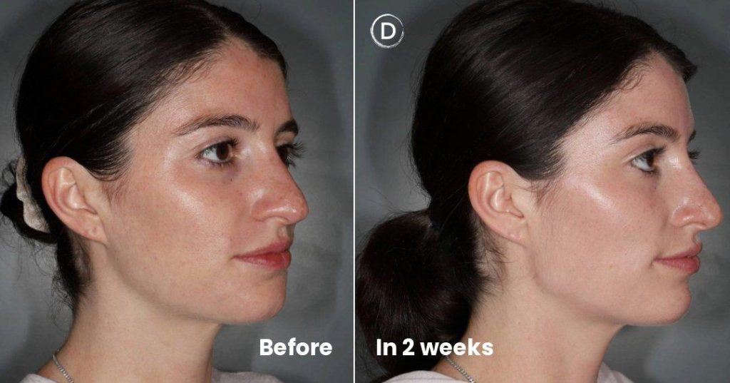 Before and after chin and jawline structural filler at Dermatology Circle NYC