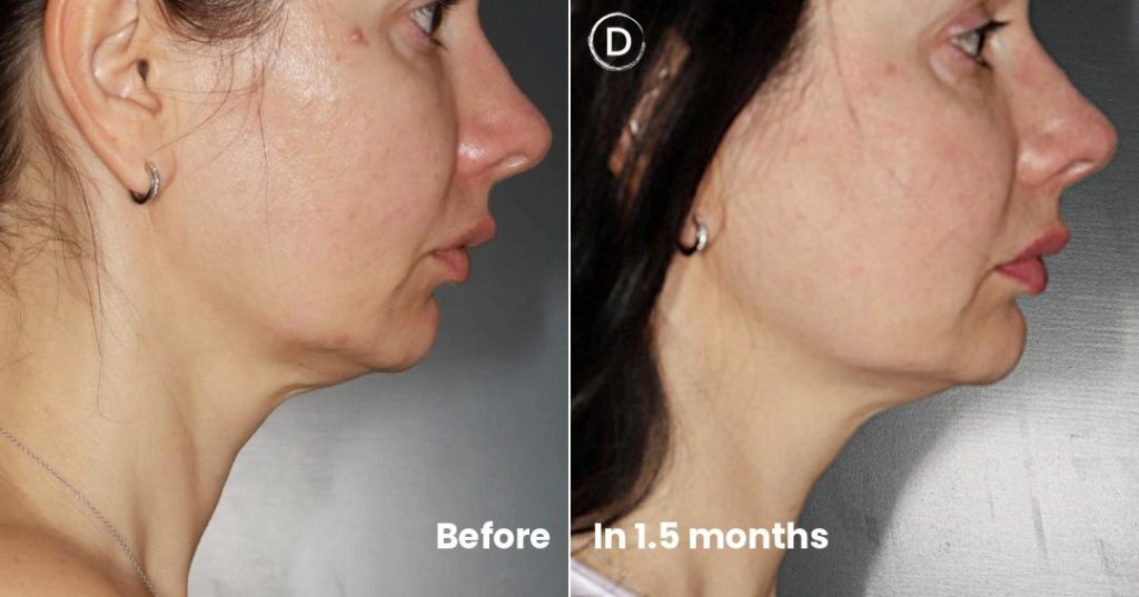 Before and after Sofwave treatment for lower face and jawline definition in NYC