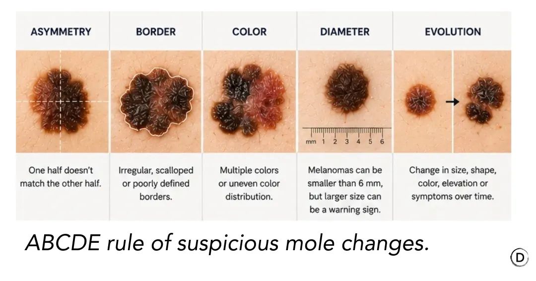ABCDE rule for suspicious moles showing asymmetry, irregular borders, color variation, diameter and evolution.
