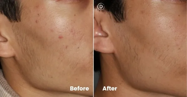 Before and after acne scar treatment showing improvement in skin texture and acne scarring.