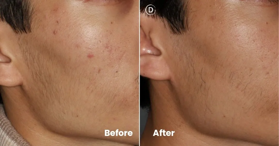 Before and after acne scar treatment showing improvement in skin texture and acne scarring.