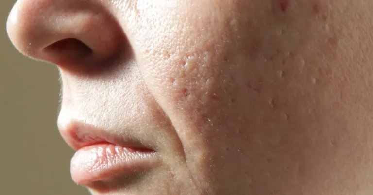 Close-up of atrophic acne scars and uneven skin texture on the cheek.