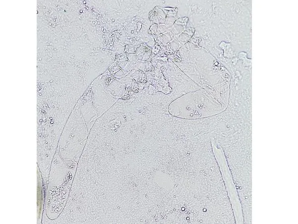 Demodex mites under microscopy during evaluation of rosacea-like facial redness