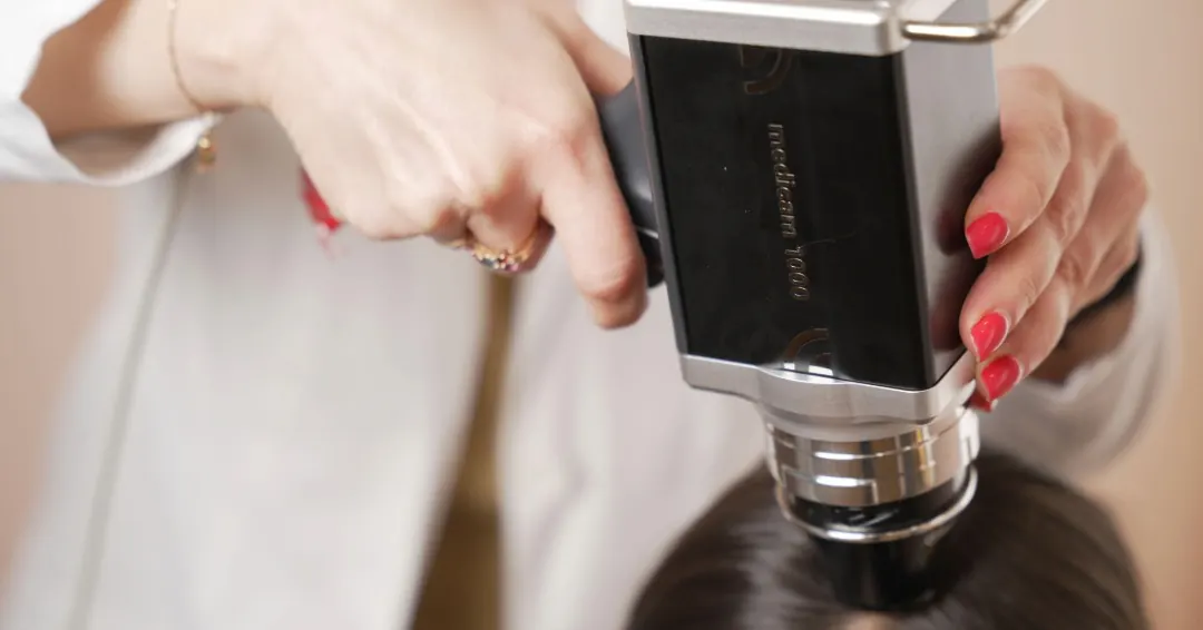 Digital trichoscopy scalp examination used to evaluate hair loss and hair follicle health.