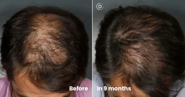 Before and after hair density improvement after 9 months of dutasteride mesotherapy for pattern hair loss.