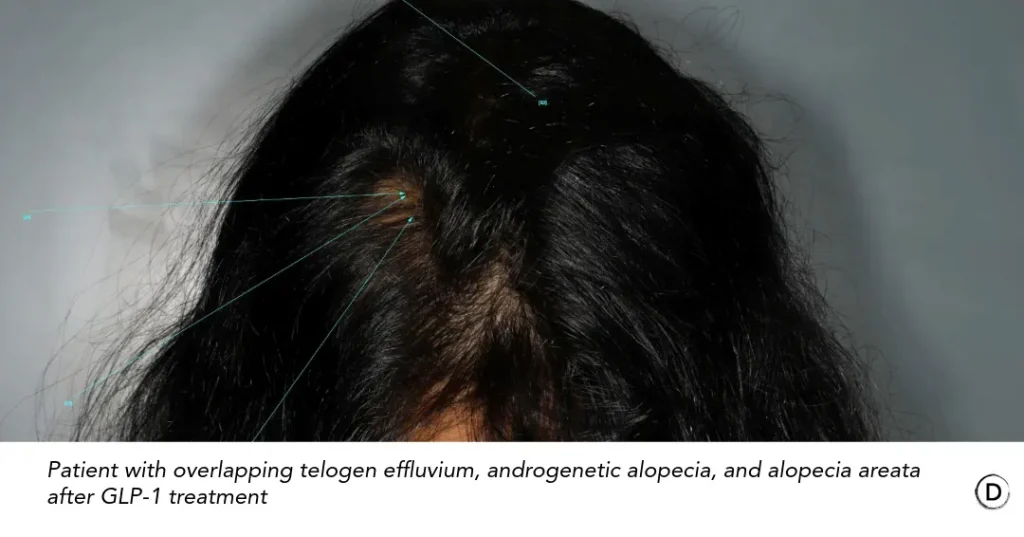 Patient with telogen effluvium, androgenetic alopecia and alopecia areata after GLP-1 treatment.