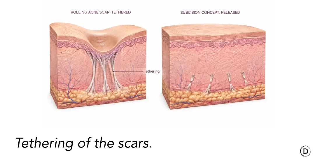 Illustration showing tethered rolling acne scars and how subcision releases fibrous scar bands.