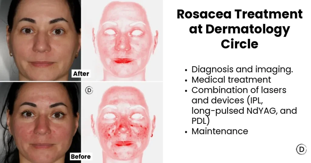 Before and after rosacea treatment at Dermatology Circle showing improvement in facial redness