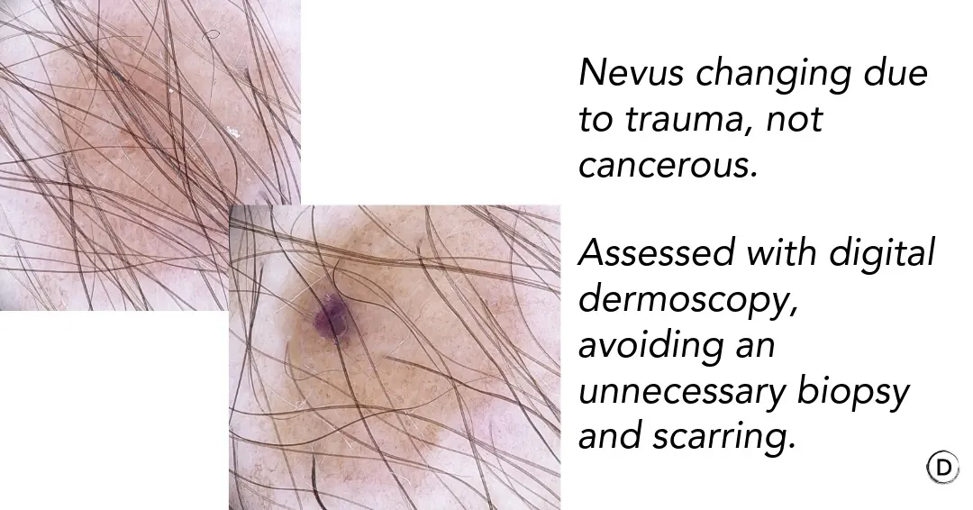 Digital dermoscopy of a traumatized nevus showing benign changes and helping avoid an unnecessary biopsy.