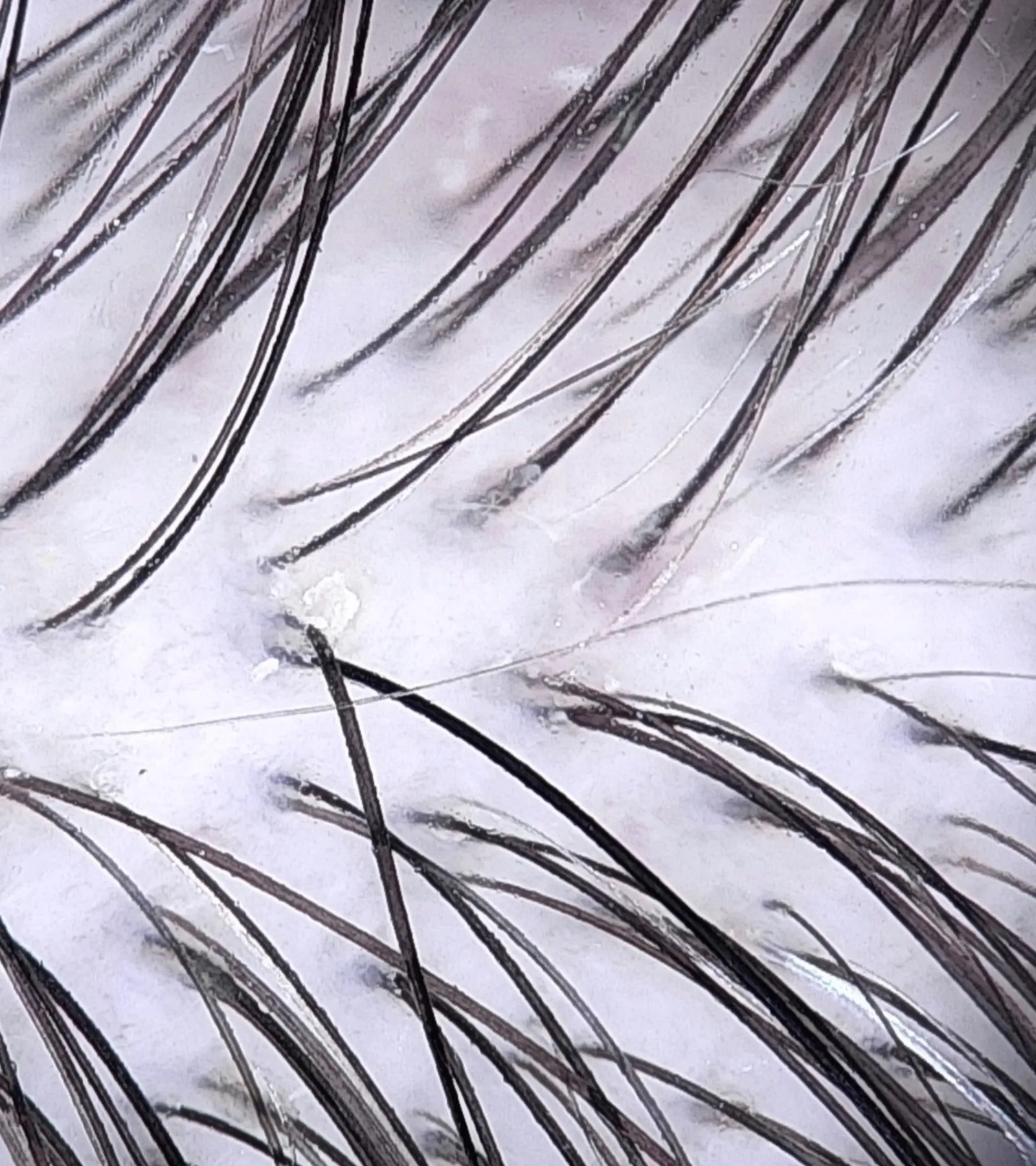 Digital trichoscopy and scalp analysis before hair transplantation