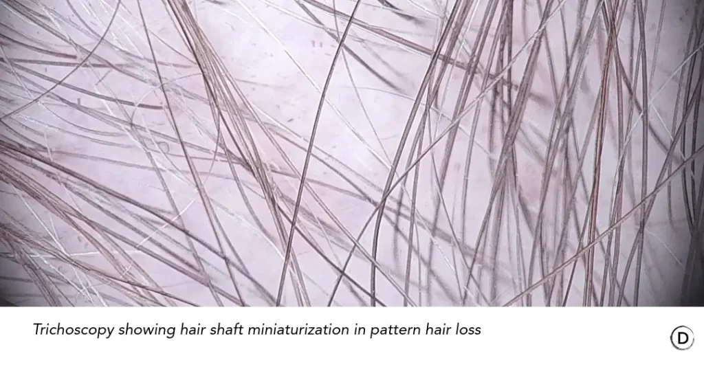 Patient with telogen effluvium, androgenetic alopecia and alopecia areata after GLP-1 treatment.
