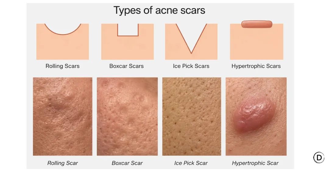 Types of acne scars including rolling, boxcar, ice pick and hypertrophic scars.