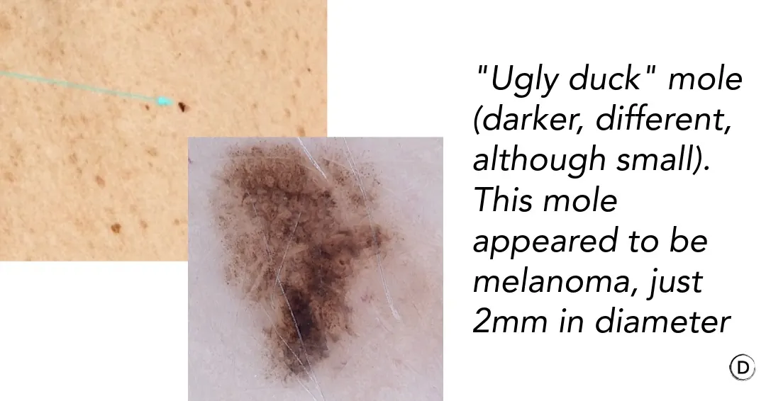 Dermoscopy of an ugly duckling mole with features suspicious for melanoma despite its small size.
