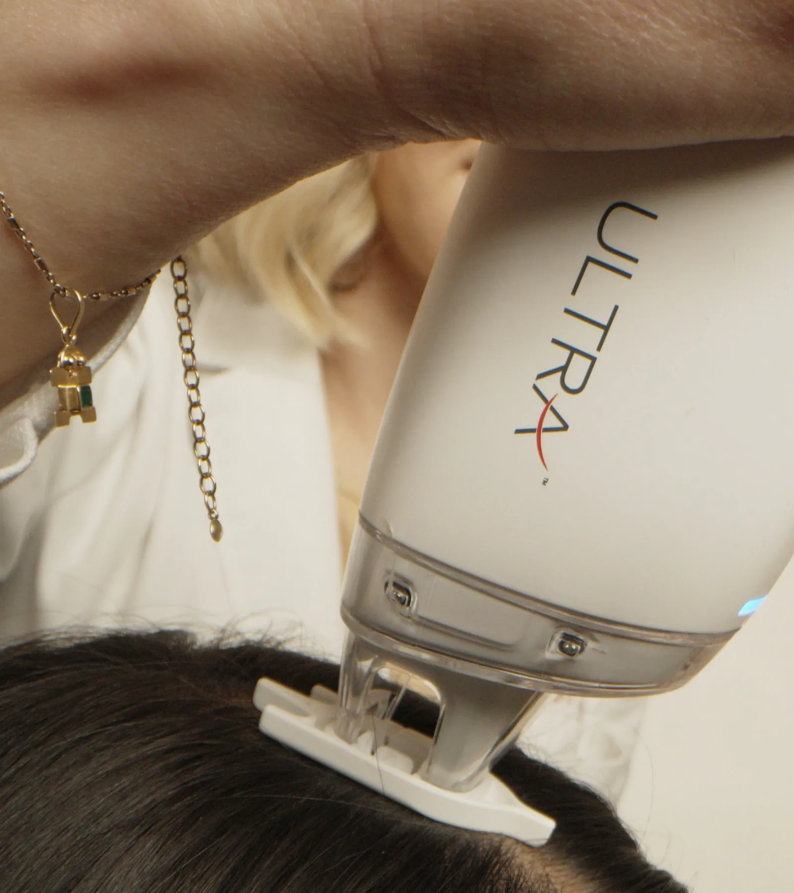 Ultra laser treatment used in physician-led hair restoration care