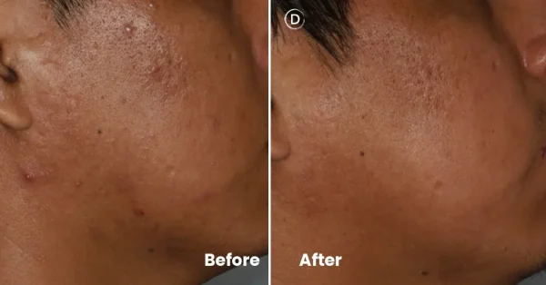 Before and after isotretinoin treatment for acne showing improvement in inflammatory breakouts and overall skin clarity.
