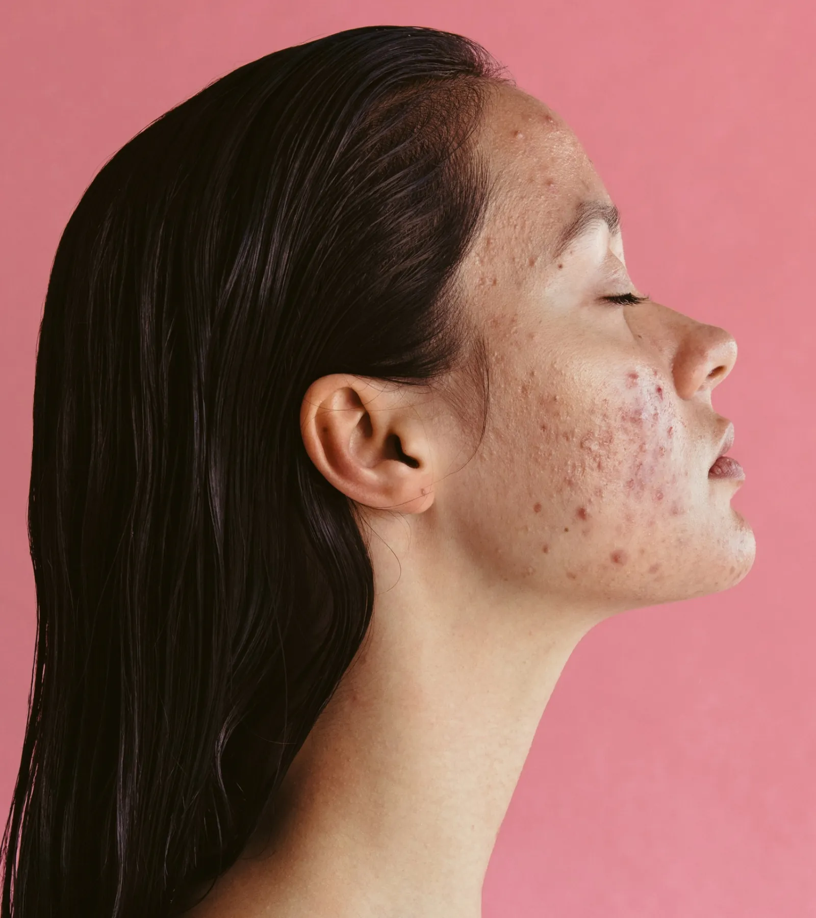 Profile view showing acne scar texture for clinical assessment in NYC