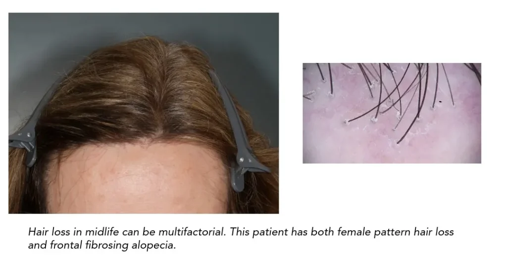 Female pattern hair loss with frontal fibrosing alopecia showing recession at the frontal hairline and trichoscopy findings.