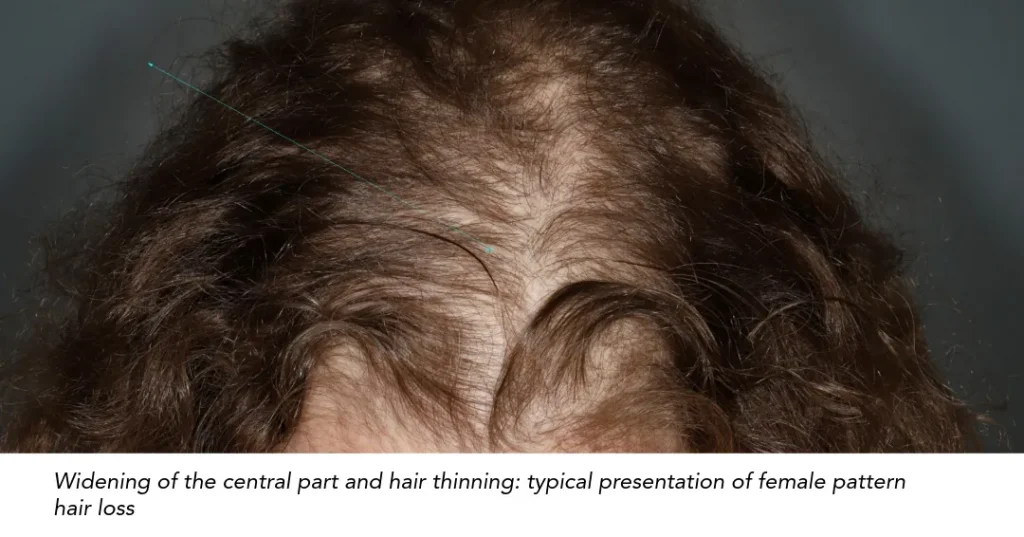 Widening of the central part and diffuse thinning typical of female pattern hair loss.