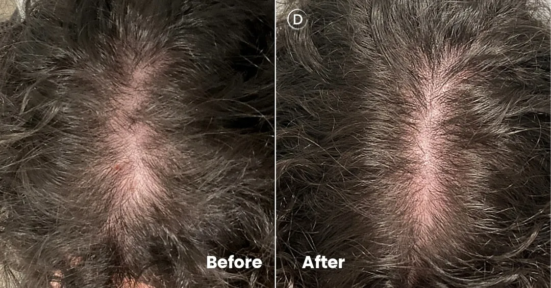 Before and after results of female pattern hair loss treated with oral minoxidil, showing improved hair density.