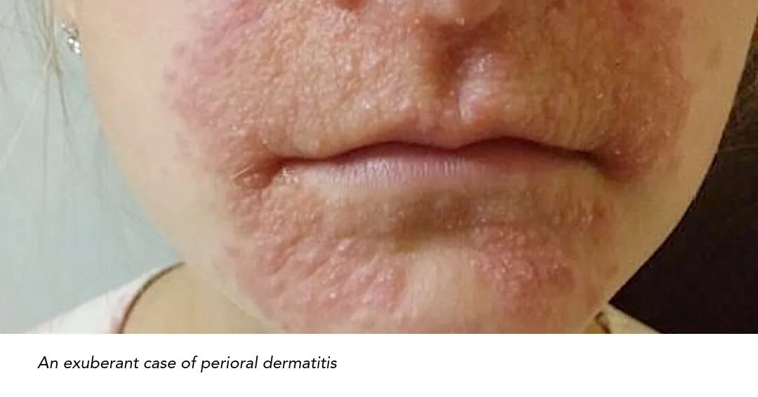 Close-up of perioral dermatitis with inflammatory papules and redness around the mouth and chin.