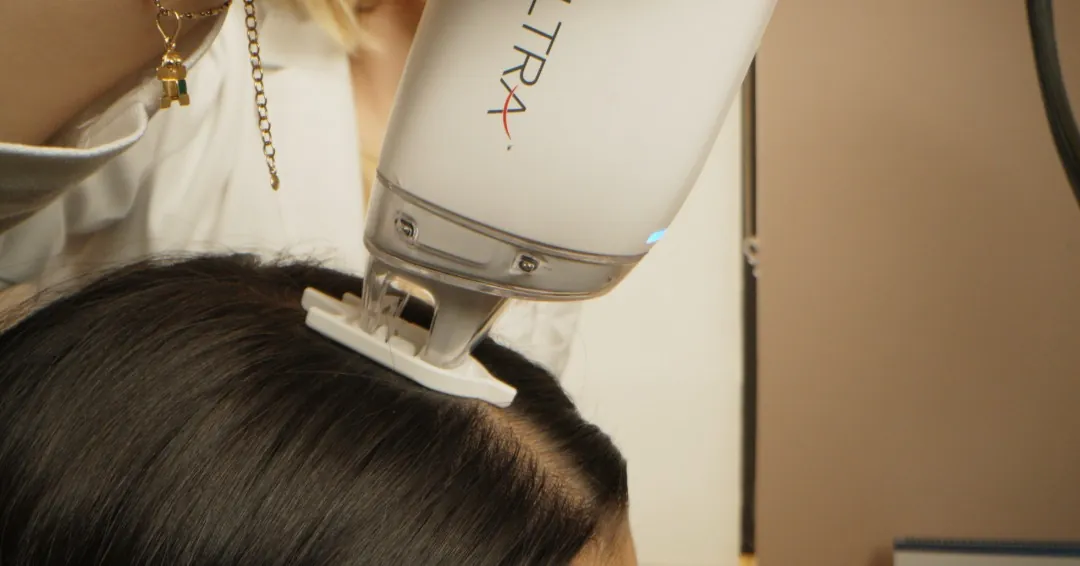Laser treatment being performed on the scalp as part of a hair loss treatment plan.