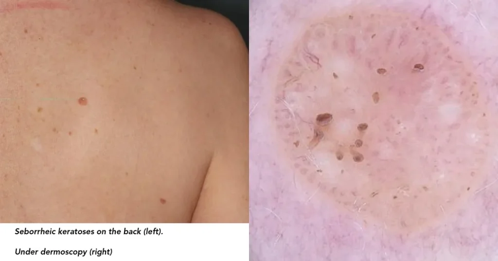 Seborrheic keratoses on the back with dermoscopic close-up